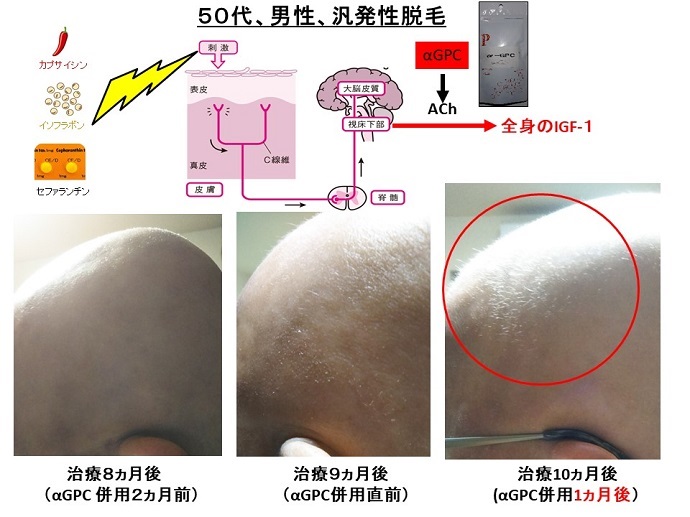 円形脱毛症　病院
